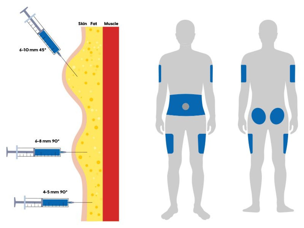 Injection Sites For Insulin Administration Do You Rotate Your Injection Sites For Insulin Administration Do You Rotate Your