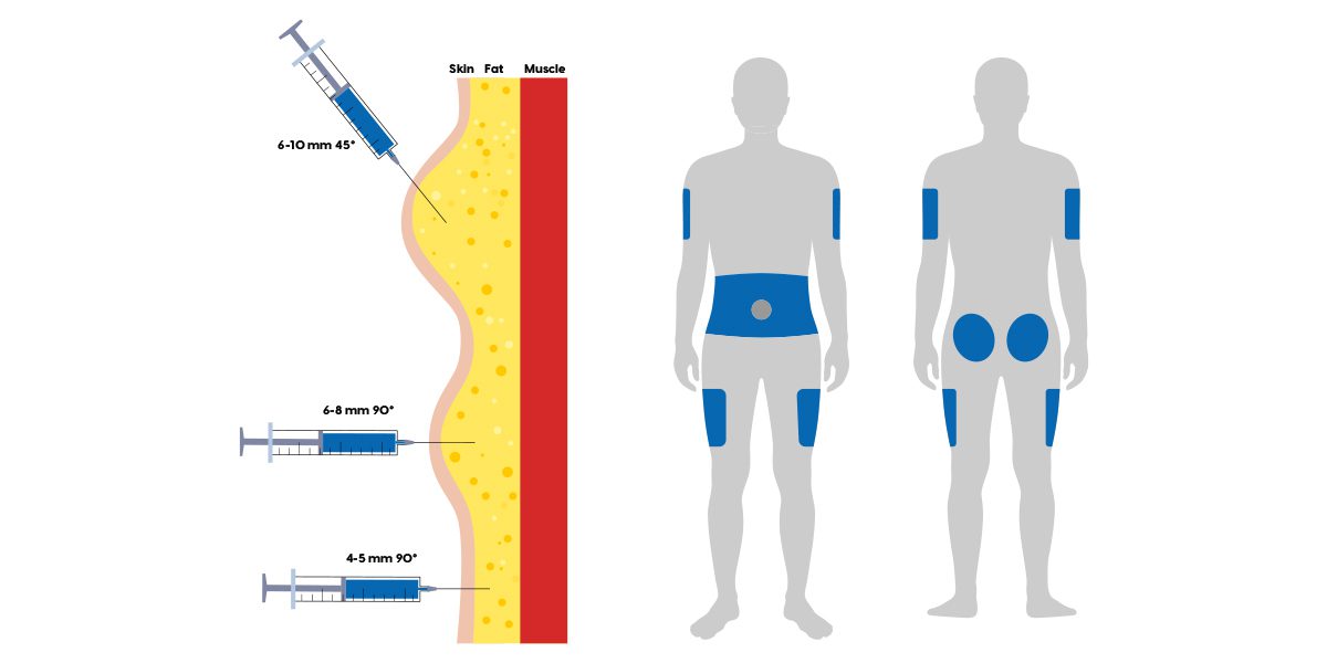 Where To Give Insulin Injections GBMBY Where To Give Insulin Injections GBMBY