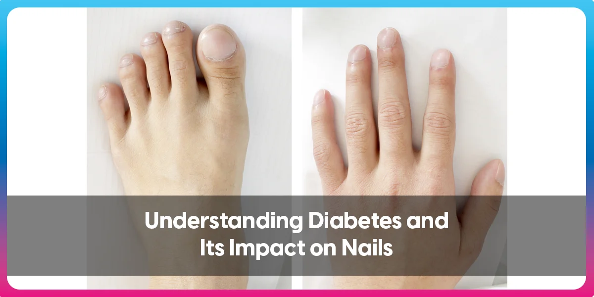 Understanding Diabetes and Its Impact on Nails copy_11zon