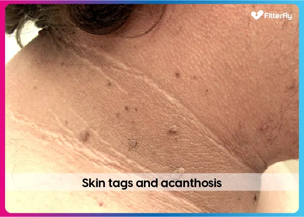 Skin Tags and Acanthosis